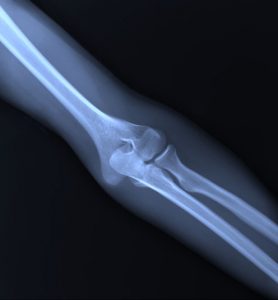 Arthroscopic Elbow Synovectomy