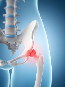Partial Hip Replacement