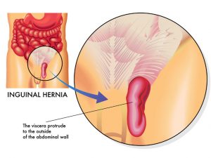 Laparoscopic Inguinal-Femoral Hernia Repair