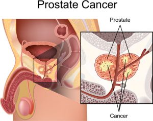 High Dose Rate Brachytherapy for Prostate Cancer